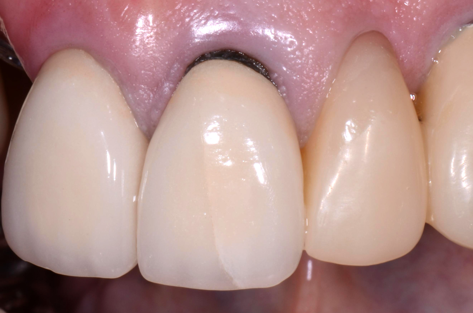 Black Stains On Teeth Near Gums TeethWalls